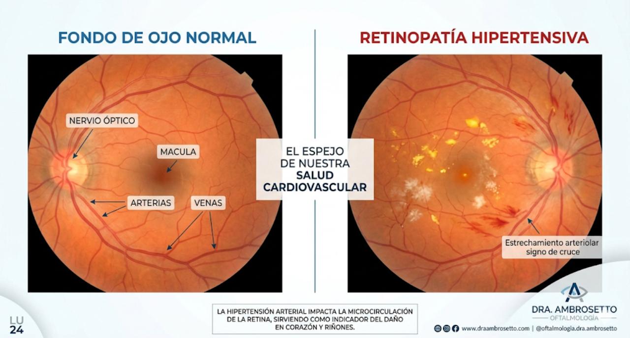 Retinopatía Hipertensiva: El Espejo de nuestra Salud Cardiovascular