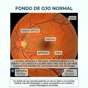 Retinopatía Hipertensiva: El Espejo de nuestra Salud Cardiovascular