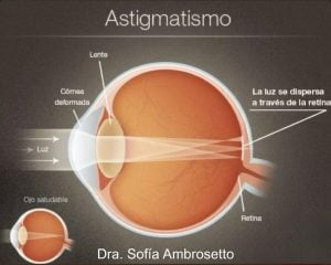 Astigmatismo: Un Análisis desde la Arquitectura Corneal y la Óptica de Precisión